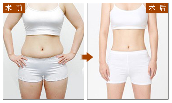 吸脂,瘦身,对比图,长春好的整形医院