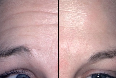 长春保妥适,长春哪里能注射botox,长春好的整形医院