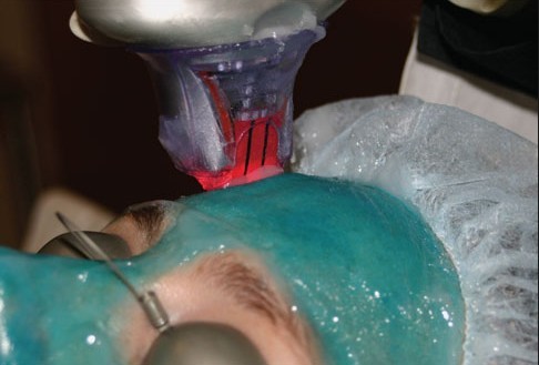 长春激光治疗黄褐斑,长春好的整形医院