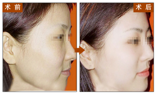 激光,祛斑,对比图,长春好的整形医院