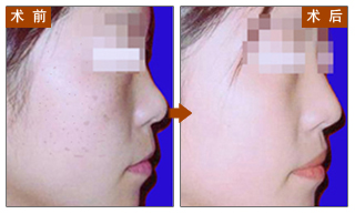 长春彩光嫩肤，光子嫩肤，长春好的整形医院