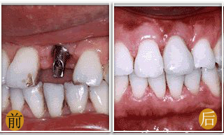 长春口腔,种植牙,种植牙好处